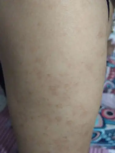 母亲的手臂上长了这样的斑 是什么症状 告诉一下 谢谢