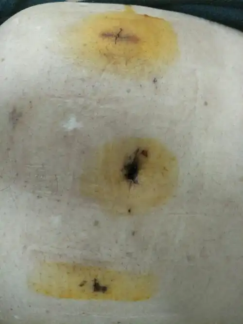 青海省康乐医院肛肠泌尿科成功开展腹腔镜下精索静脉曲张结扎术