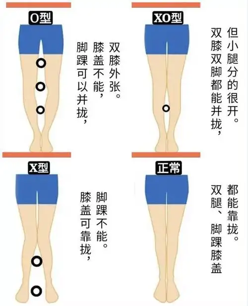 考虑到有些姐妹分不清,x型腿和o型腿的区别,先用一张图来给大家解说一