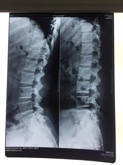 阜阳市中医医院骨科腰椎间盘巨大突出小切口开窗减压一例