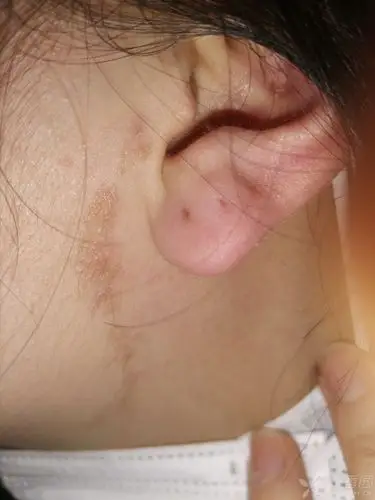 线状表皮痣皮脂腺痣