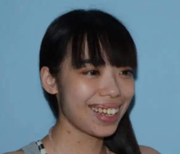 龅牙矫正可以变美且看龅牙妹颜值逆袭之路