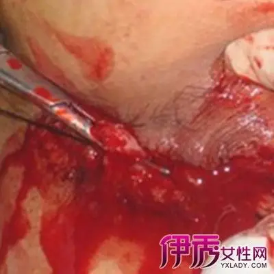 割痔疮手术过程图片大全 其临床表现和治疗方法介绍