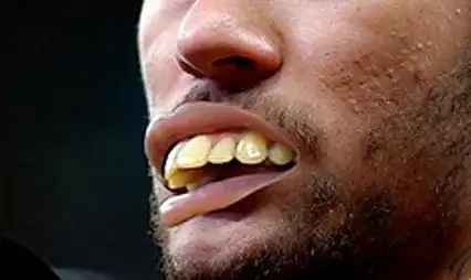 龅牙对人的相貌有很大的影响,龅牙主要为骨突造成的牙齿畸形,进行