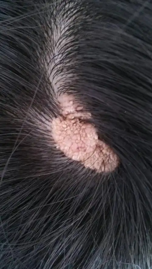 头顶部长出肉芽一样的东西,现在越来越大了,有拇指般大小,担心是什么