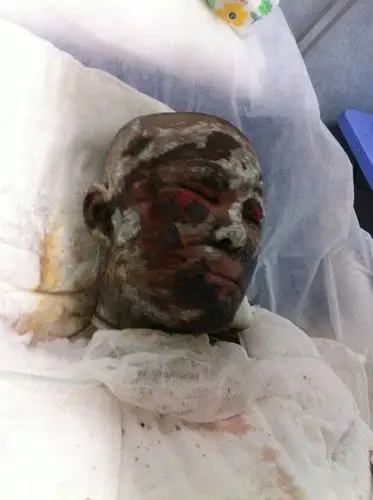 漳浦少女全身特重度烧伤抢救中 父亲两入火海救出女儿