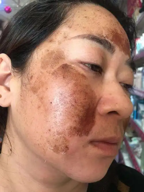 真皮斑的全过程