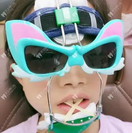 5岁孩子戴儿童反颌矫正牵引器面弓,矫治地包天的疗效反馈 - 前沿技术