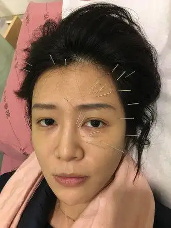 慎入文汶半边脸插满20针灸下眼睑狂跳一个月面瘫