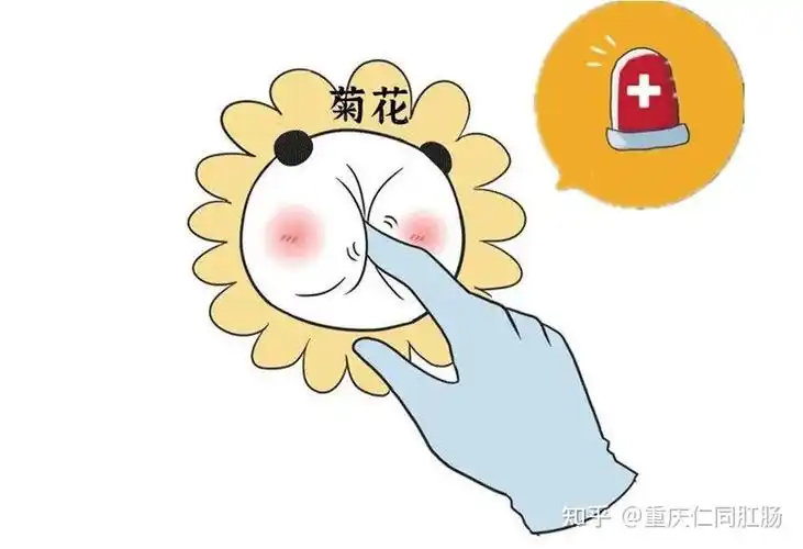 肛门息肉与痔疮有什么区别重庆仁同肛肠医院好