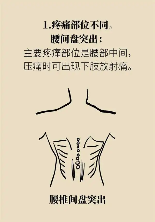 腰肌劳损和腰间盘突出都会腰疼平常如何区分呢