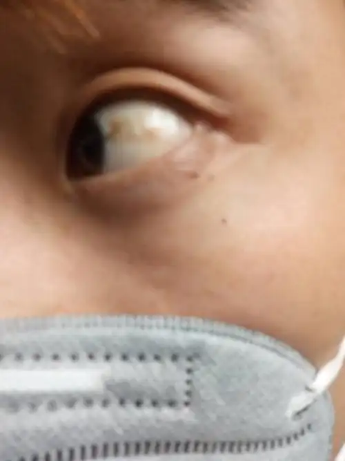 白眼球上有黄斑,而且很明显变大了.稍微感觉有点凸起的感觉.怎么回