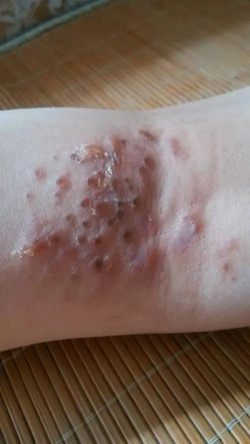 我女儿这几天膝关节内侧长了些类似脓包的东西,请问这是什么东西,如何