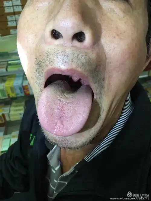 舌像图,近一年来经历过病人的舌像. - 美篇