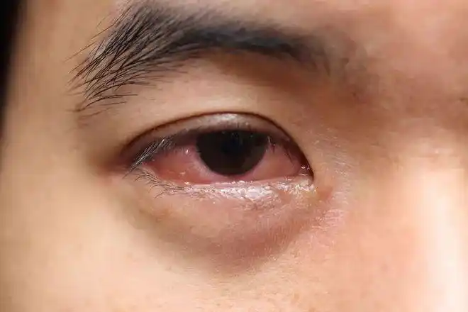医生门诊病例揉眼睛惹出惊人大祸视网膜脱离失明大人孩子都中招