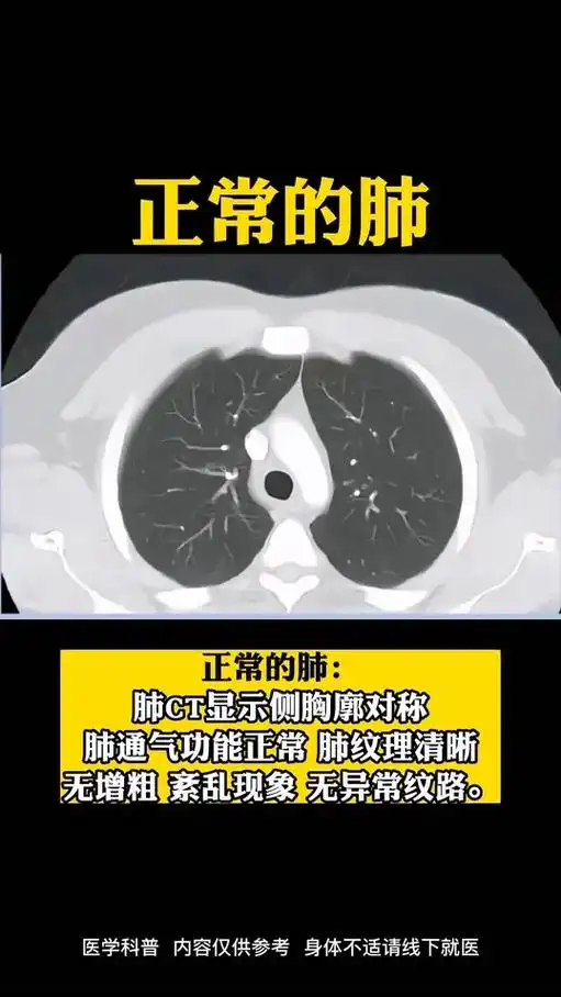 图1:是正常肺部的ct图像,没有显示出任何结节. 图2:显示 - 抖音