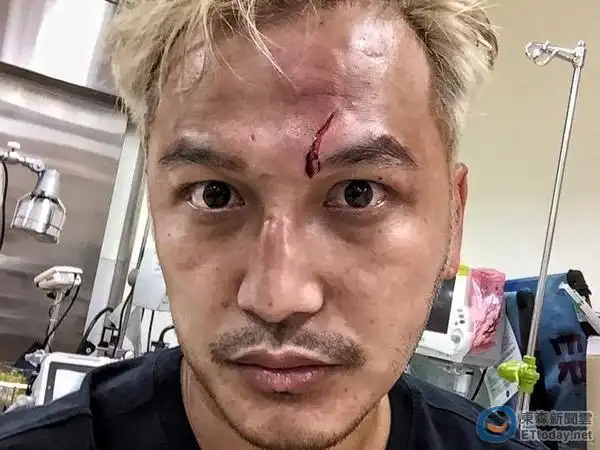 kid抄球被撞飞「脑袋著地」缝9针 man回:伤疤是勋章