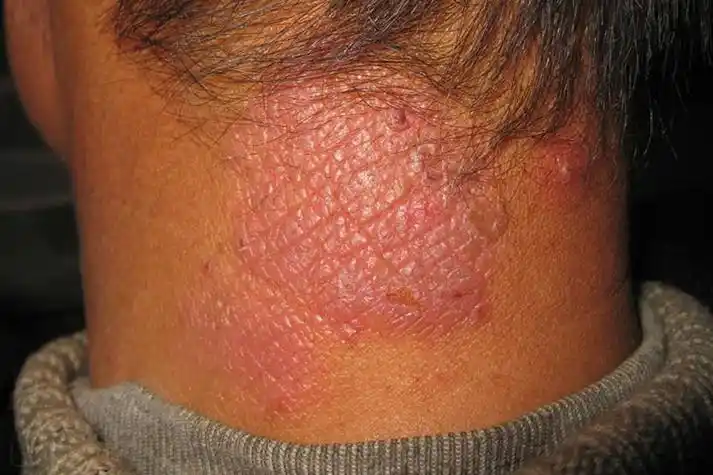 神经性皮炎图片