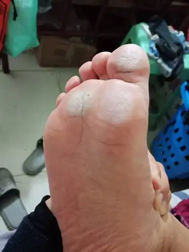脚底下白白的是什么原因造成的