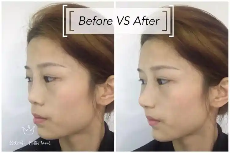 讨喜hani扁平脸该如何改善凄苦相