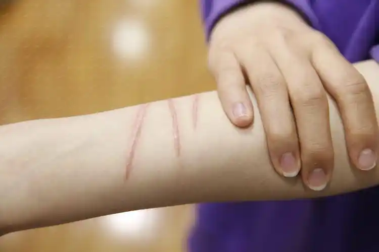 每天看着手伤口图片手腕伤口真实图片女生手伤疤图片真实手上伤疤图片