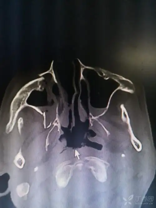 这个上颌窦骨折需要手术吗?