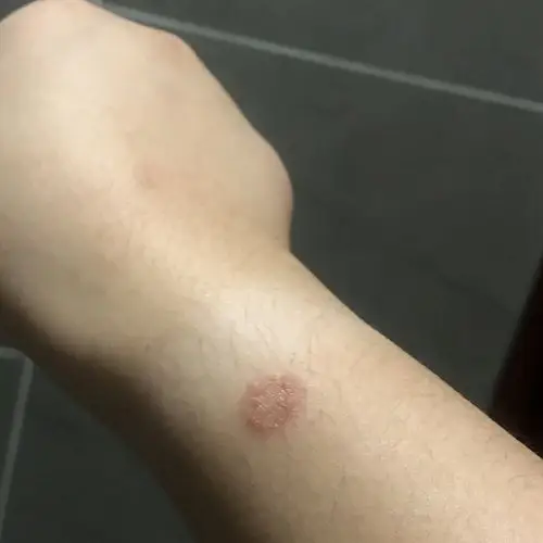 【讨论】我身上长藓了,是猫的问题吗.