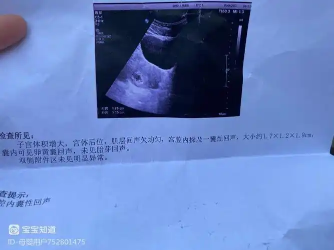 这是怀孕50天的孕囊能看男女吗?