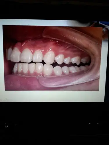 尖牙保护合:指下颌做侧方运动时,工作侧只有尖牙接触,平衡侧牙齿不