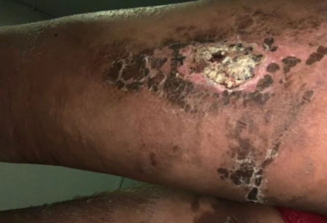 外力作用,导致血管破裂;术中局部反复抽吸过度造成局部皮下形成死腔