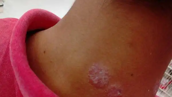 圆形的,起白屑,这是什么类型的皮癣呢?