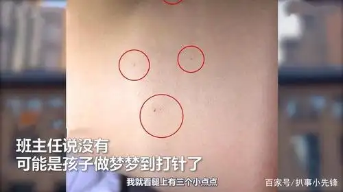 陕西一3岁女童身上有29处针眼,女孩:老师只给我打了针