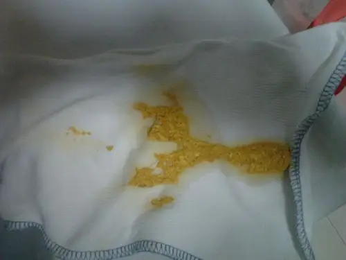 00 网友采纳   看不太清晰,好像有奶瓣,小米样的大便是没消化的脂肪