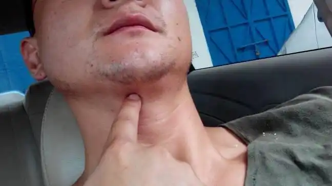 下巴淋巴结肿大图 (26)_有来医生