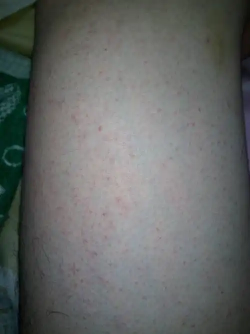 这两天全身突然起了很多小红点,挺痒的,晚上更是