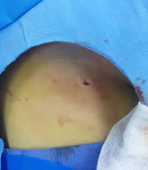 一次手术成功栓塞颅内双侧3枚动脉瘤