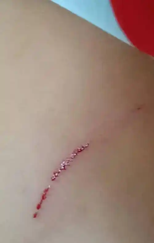 南宁12岁女孩衣服被划破背部有一道深深的血痕这是怎么了