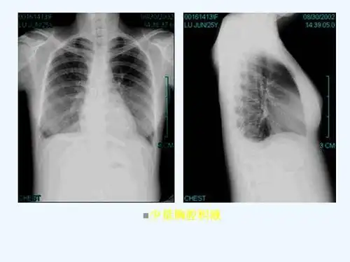 胸腔积液的影像诊断课件