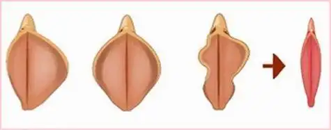 两边肉特别长极有可能是尿道口息肉的表现引起的,此病又名尿道肉芽肿