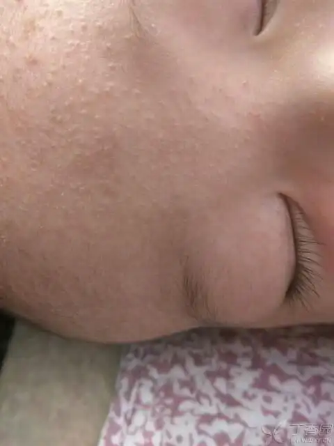 宝宝额头上的密密麻麻小疙瘩,请各位皮肤科老师给个诊断和治疗建议!