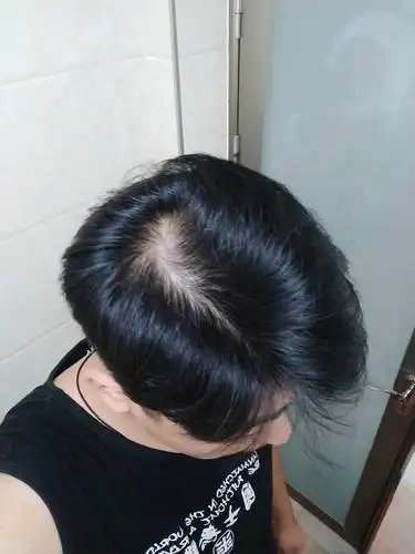 我二十七岁了突然头发头顶脱发怎么回事啊家里也没有遗传啊