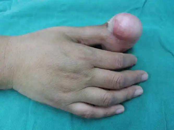 大为建议选择修复外观改善功能保留拇指不要切除"如果患肢是其他手指