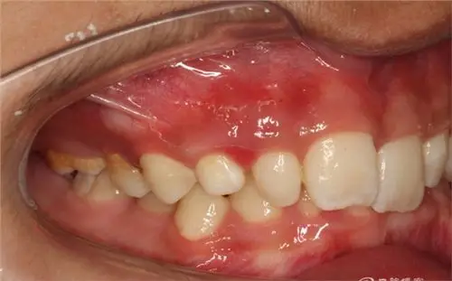 【原创博客】埋伏尖牙的外科电刀开窗导萌