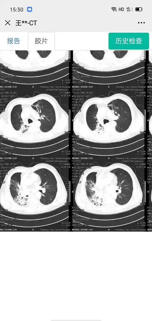 三次肺炎ct片子