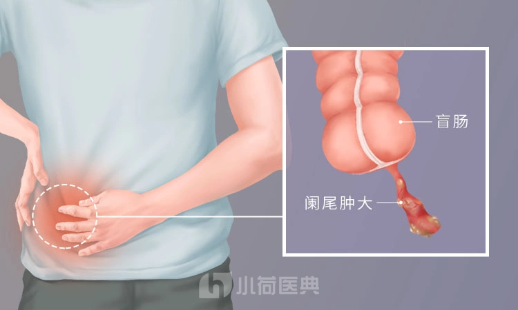 阑尾炎的疼痛位置在哪里?