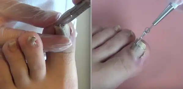 医生拿工具「用力一挖」没想到指甲最后竟然.