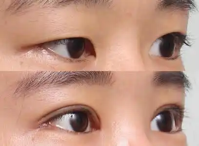 希克丽医院全切双眼皮开眼角闪闪惹人爱