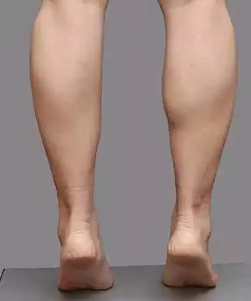 女孩子腿粗怎么办?肌肉腿,脂肪腿.不同的细腿方法!