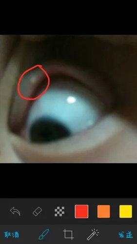 眼睛里面长了小肉粒,如图,没有感觉不痛不痒,这是