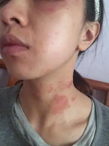 颈部及脸部皮肤红痒刺过敏表皮有点粗